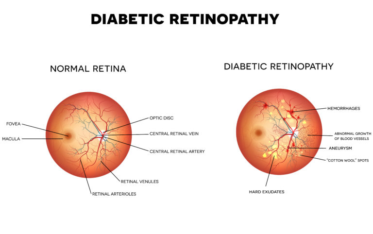 Normal Retina vs Diabetic Retina