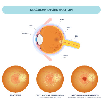 dry vs wet macular degeneration