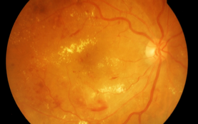 Diabetic-Retinopathy-Photo-1